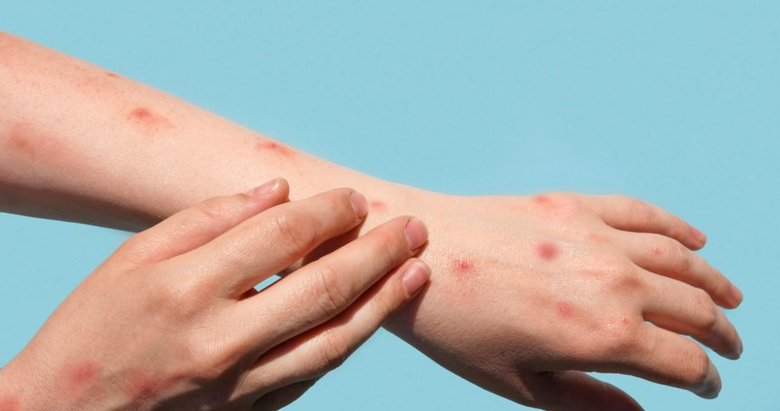 Türkiye’de Maymun Çiçeği vakası var mı? Sağlık Bakanlığı’ndan önemli açıklama