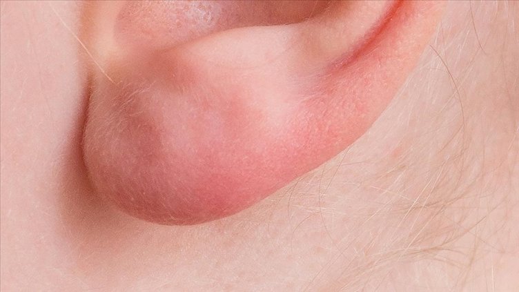 Kulak memesindeki bu çizgiye dikkat! Kalp hastalığının belirtisi olabilir