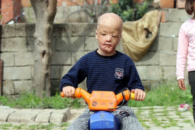 Minik Halil’in yanığına su oldular! 3 günde mucize gerçekleşti...