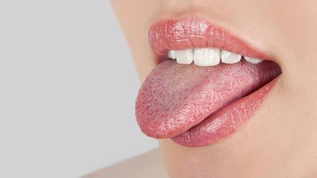 Diliniz yanığı nasıl geçer ve iyileşir?