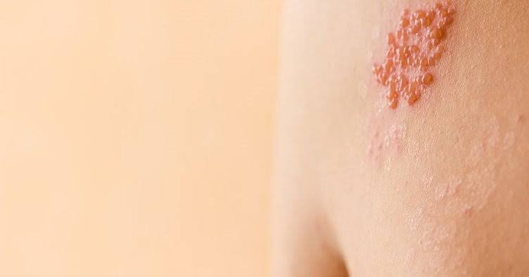 Zona hastalığı nedir, belirtileri nelerdir? Zona hastalığı tedavisi var mı?