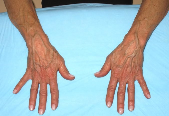 Vucuttaki Damarlarin Belirginlesmesinin Nedenleri Galeri Yeni Asir