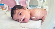 Minik Eymen’in boynundan 445 gram tümör çıkarıldı