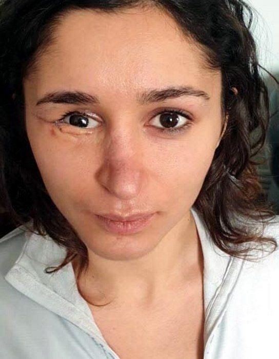 Sevgilisi tarafından şiddete uğrayan Tuğçe hukuk mücadelesi başlattı