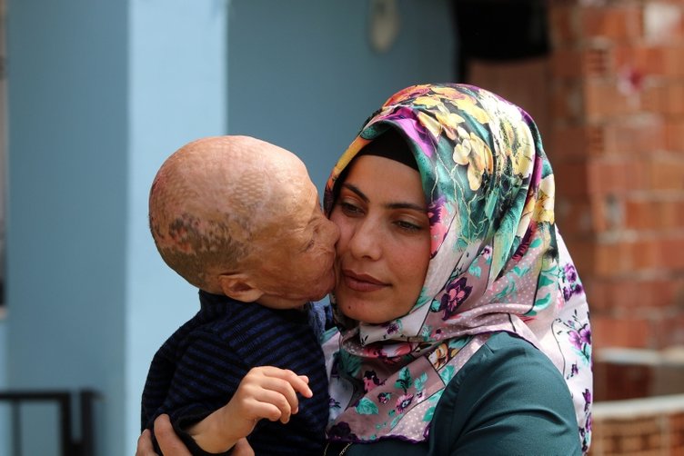 Minik Halil’in yanığına su oldular! 3 günde mucize gerçekleşti...