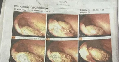 Manisa’da inanılmaz ihmal! İç organını delip geçmiş