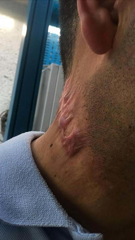 Lazer tedavisi sonrası hayatı karardı! Soluğu mahkemede aldı