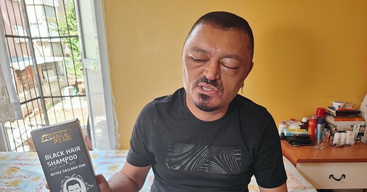 Adana'da talihsiz olay! Sadece saçlarını siyahlaştırmak istemişti… İnternetten aldığı şampuan yüzünü gözünü şişirdi!