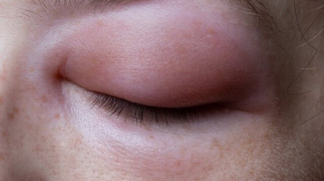 Herediter anjioödem hastalığının belirtileri nelerdir? Tedavisi var mıdır?