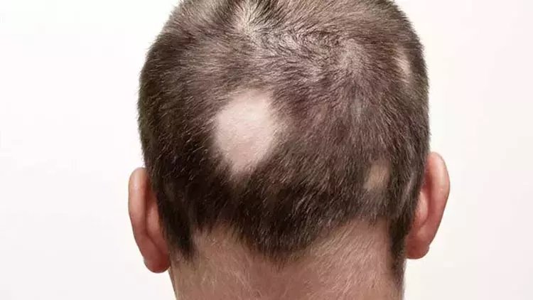 Saçkıran alopesi areata nedir, neden olur? Saçkıran hastalığının belirtileri...