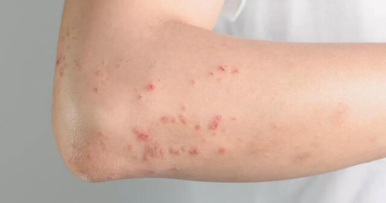 Rozasea Gül hastalığı nedir? Sebep, belirtileri ve tedavi yöntemleri nelerdir?