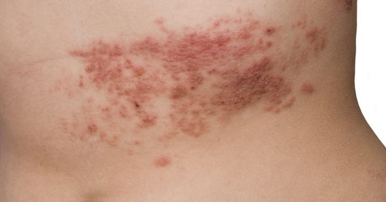 Zona hastalığı nedir, belirtileri nelerdir? Zona hastalığı tedavisi var mı?