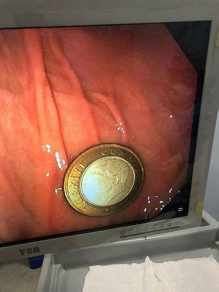 5 yaşındaki çocuğun yuttuğu madeni para başarıyla çıkarıldı