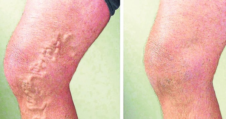 Köpükle varis tedavisinde yüz güldüren sonuçlar