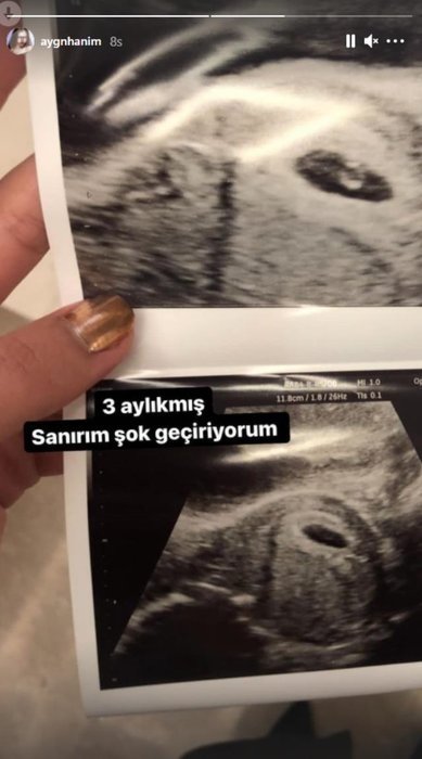 Hakan Sabancı’nın eski sevgilisi Aygün Aydın’dan şok ultrason paylaşımı! Aygün Aydın hamile mi?