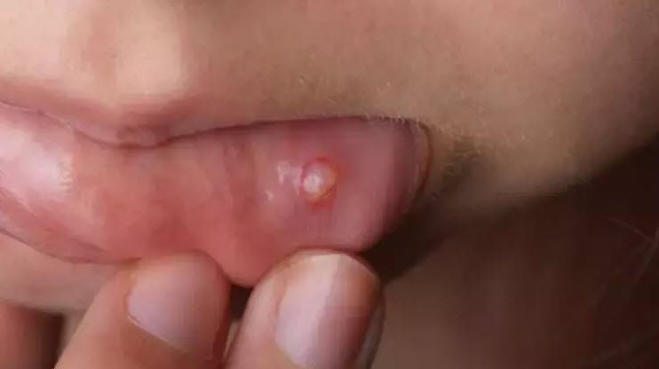 Dudaktaki uçuk en hızlı nasıl geçer? İşte püf noktaları