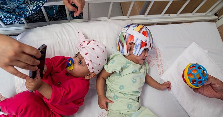 Pakistanlı yapışık ikizler Türkiye’de sağlığına kavuştu