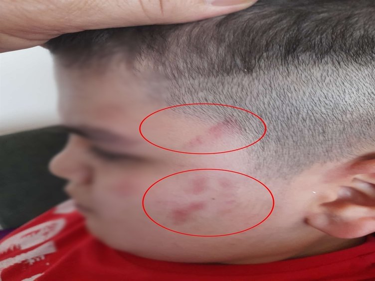 Otizmli vücudunda 54 morluk bulundu! Savcılık soruşturmasında sınıf öğretmeni açığa alındı