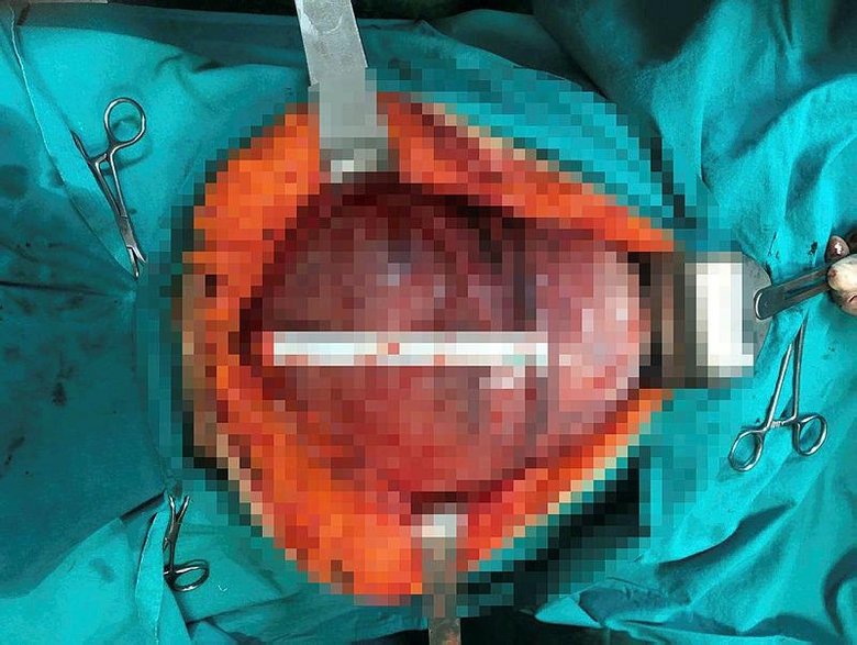 Karınlarındaki kitlelerden aynı gün kurtuldular