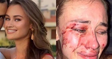 Dünyaca ünlü model Daria Kyryliuk Çeşme'de saldırıya uğradı