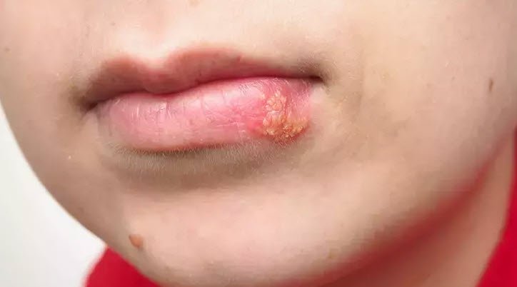 Dudaktaki uçuk en hızlı nasıl geçer? İşte püf noktaları