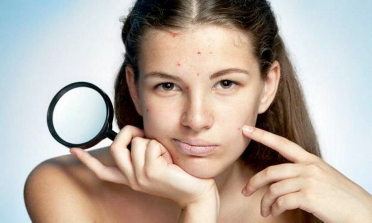 Sivilce nasıl geçer? Sivilce izi nasıl yok olur?