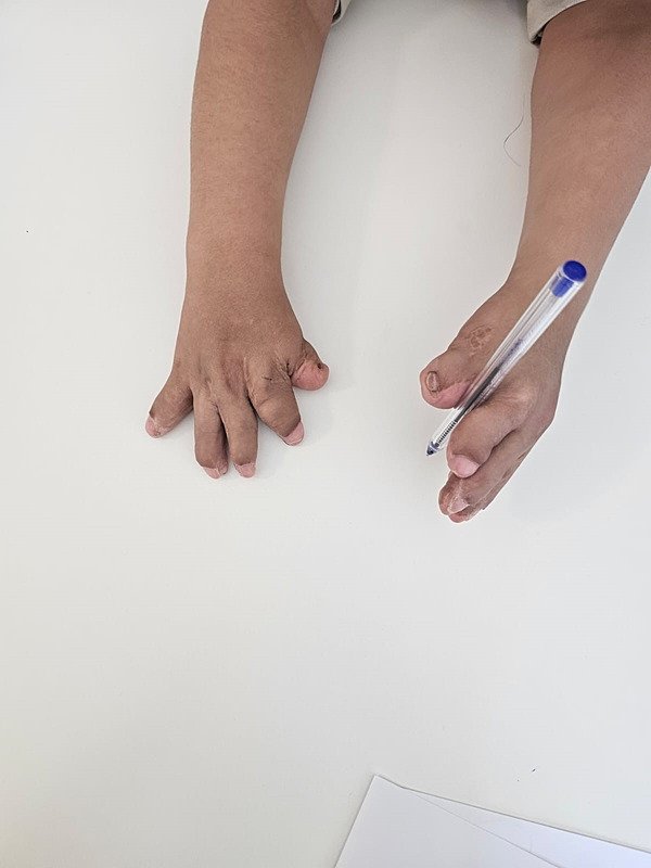 10 parmak operasyonu