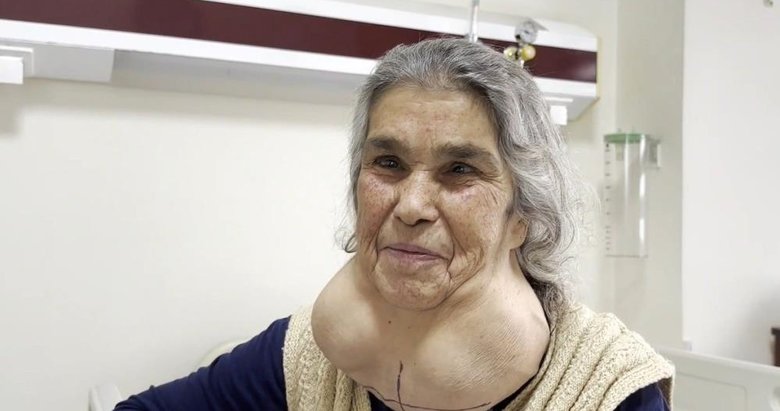 Doktordan korktuğu için hastaneye gitmedi! 50 sene boyunca boynundaki 2 kiloluk guatrla yaşadı