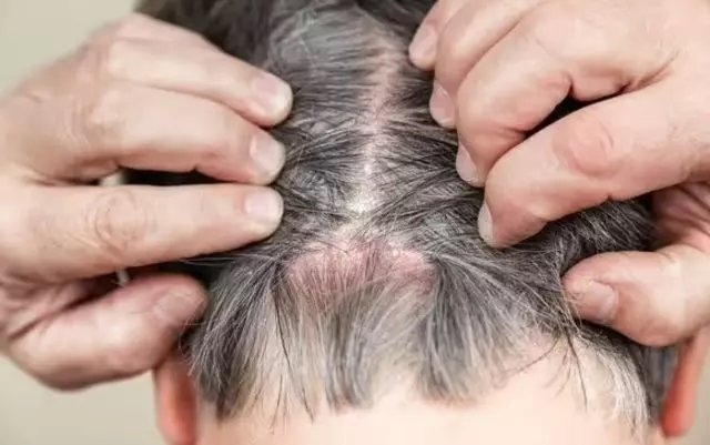Saç kepeğini görmezden gelmeyin! O hastalığın habercisi...