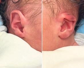 Ata bebeğin kulağını evde şekillendirdiler