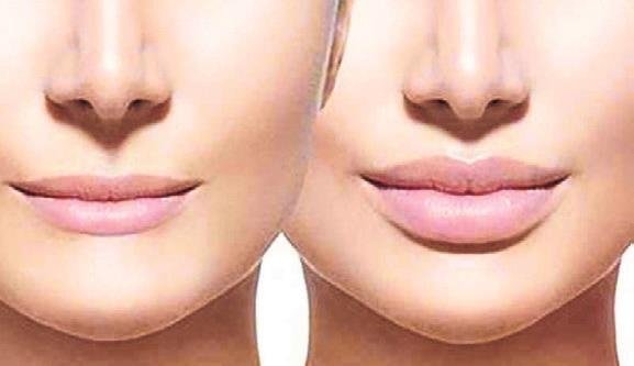 Dolgun dudaklar herkesin hayali