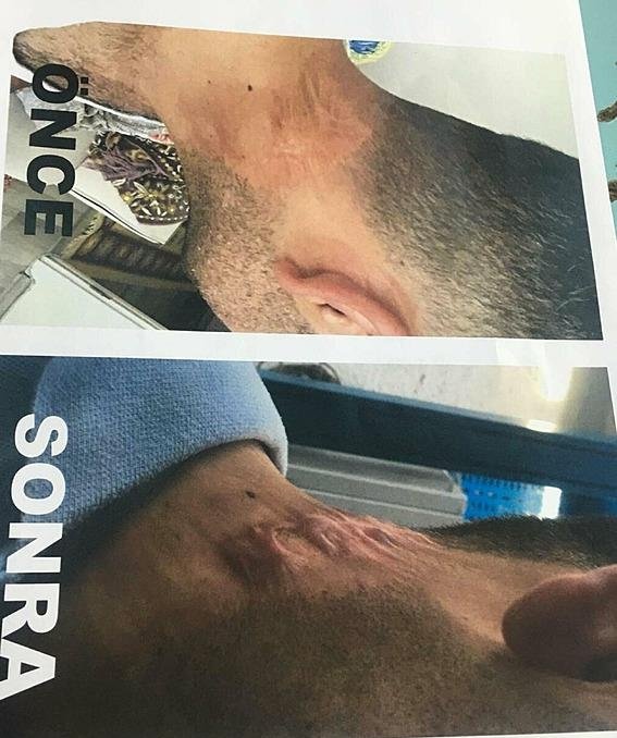 Lazer tedavisi sonrası hayatı karardı! Soluğu mahkemede aldı