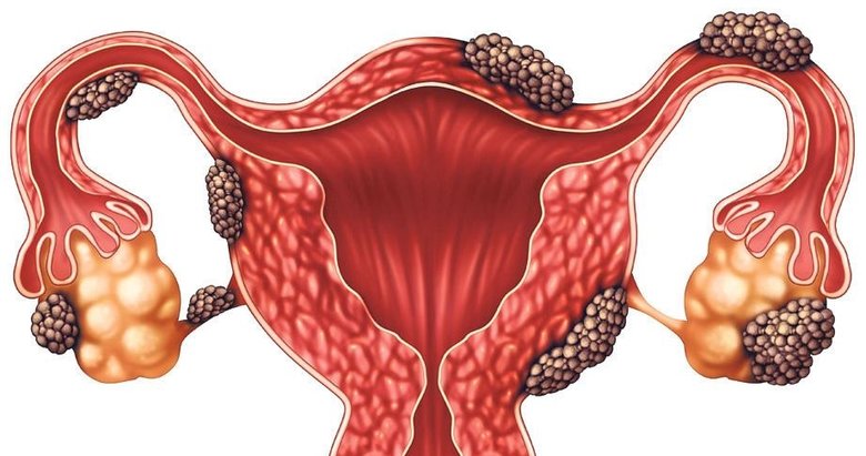 Çikolata kistine dikkat!