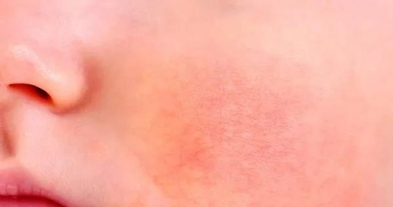 Tokatlanmış yanak sendromuna dikkat