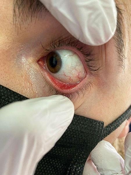 Göz iltihabı salgını yeniden başladı! Uzmanlar adenovirüse karşı uyarıyor... Bu belirtilere dikkat