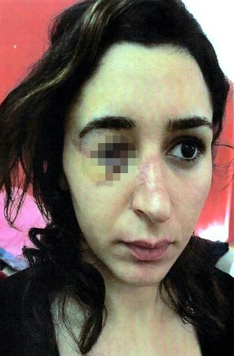 Sevgilisi tarafından şiddete uğrayan Tuğçe hukuk mücadelesi başlattı