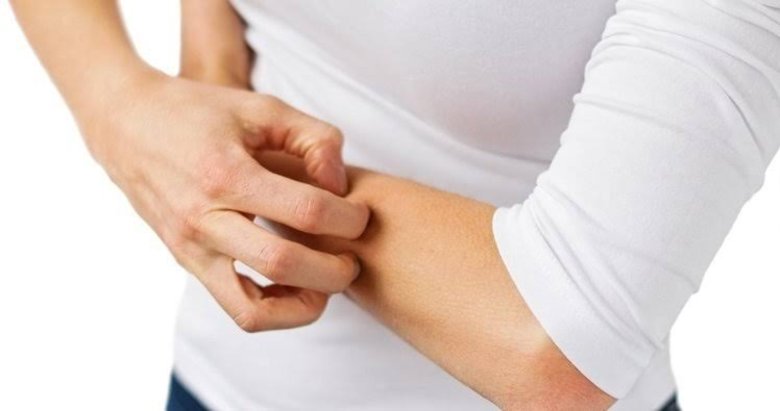 uyuz hastaligi belirtileri nelerdir