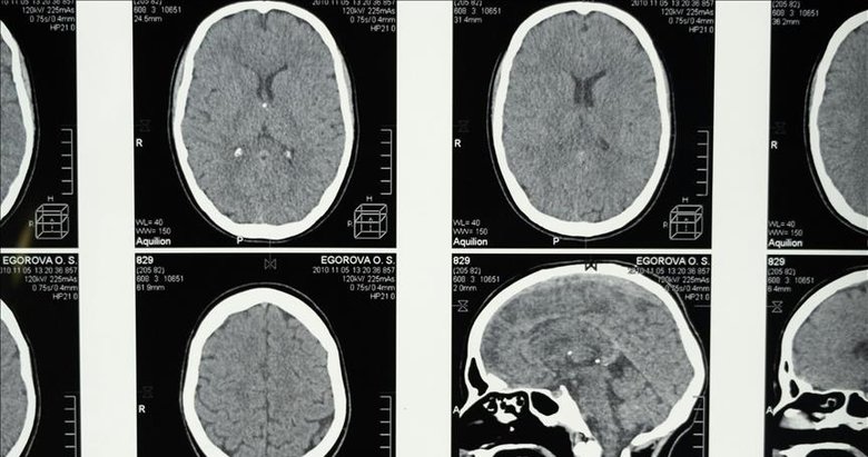 Araştırma: Uykunun REM evresine geçişte zorlanmak Alzheimer belirtisi olabilir