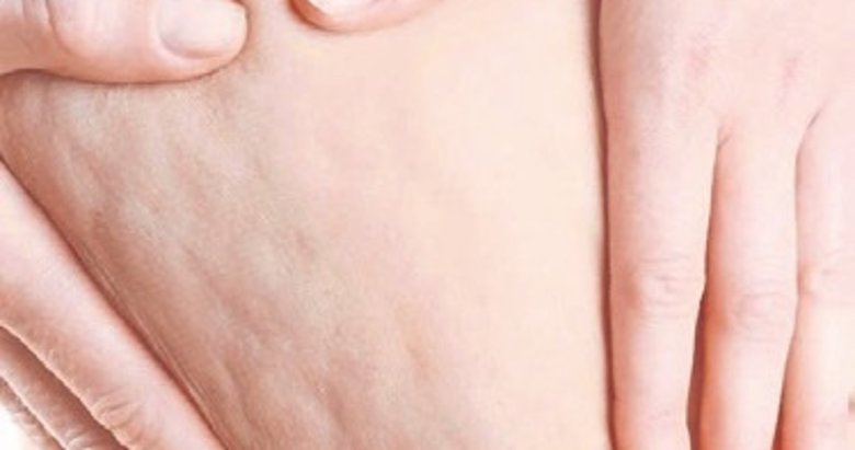 ‘Lipödem yüzeysel bir kozmetik sorunu değil’