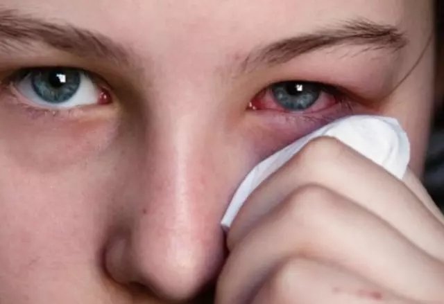 Arpacık nedir? Neden çıkar? Arpacık tedavisi nasıl yapılır?