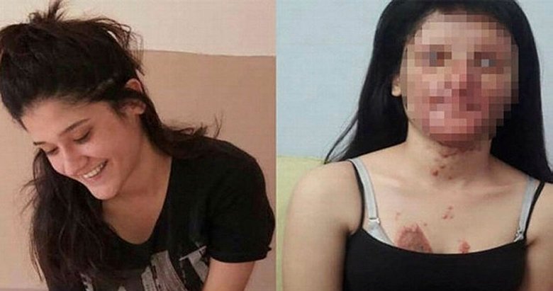 Berfin’in yüzüne asit türü sıvı atan sanık hakim karşısında