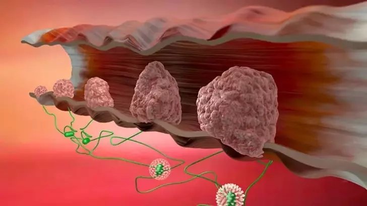 Kolon kanseri nedir? Belirtileri nelerdir?