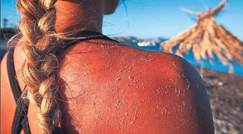 ‘Güneş yanıkları yıllar sonra kanser yapabiliyor’