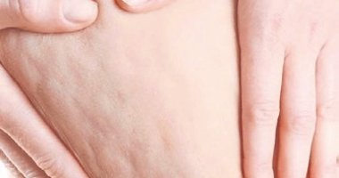 ‘Lipödem yüzeysel bir kozmetik sorunu değil’