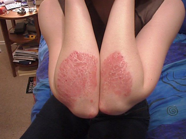 Sedef hastalığı nedir ve belirtileri nelerdir? Sedef hastalığı nasıl tedavi edilir?