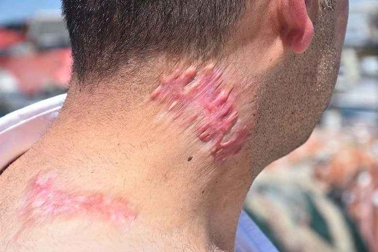 Lazer tedavisi sonrası hayatı karardı! Soluğu mahkemede aldı