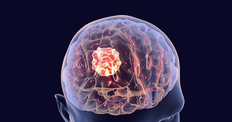 Beyin tümörü tedavisinde geç kalınmamalıdır