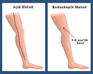 Koroner by-pass’ta bacak damarlarında kozmetik çözüm