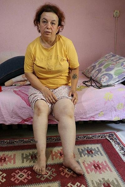 Denizli’de karın gerdirme ameliyatı olan kadının hayatı kabusa döndü