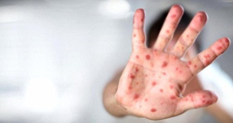 DSÖ, maymun çiçeği virüsü sebebiyle acil durum ilan etti